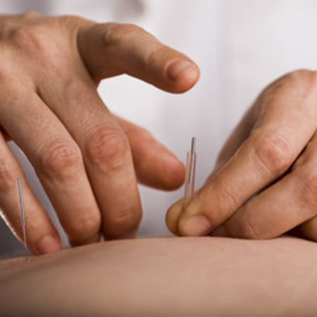 Acupuncture