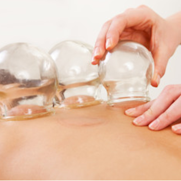 Cupping
